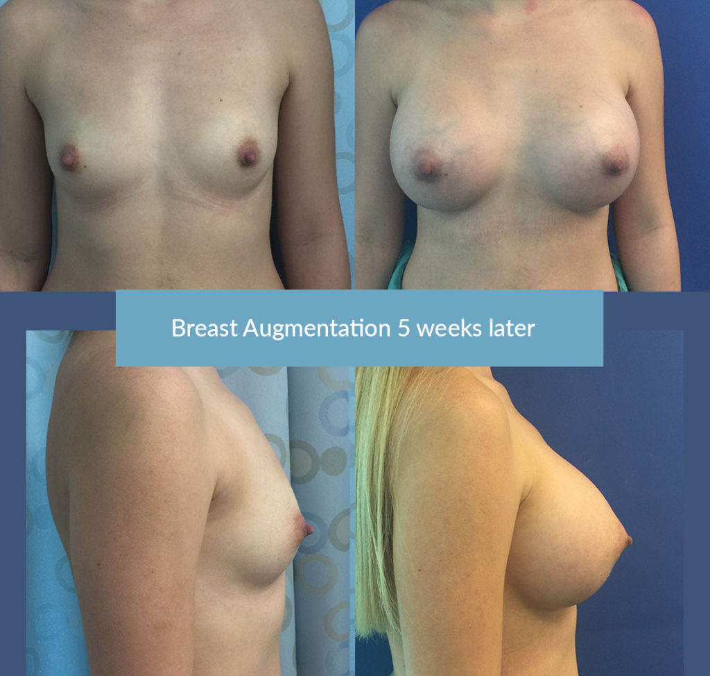 breast augmentation photo Dr. Camille Chavez