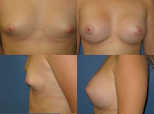 breast implant photo Dr. Camille Chavez
