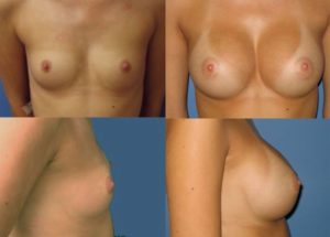 breast implants photo Dr. Camille Chavez