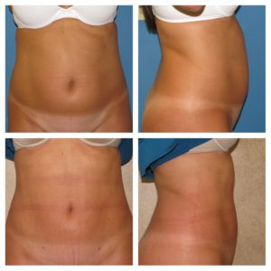 liposuction Dr. Chavez