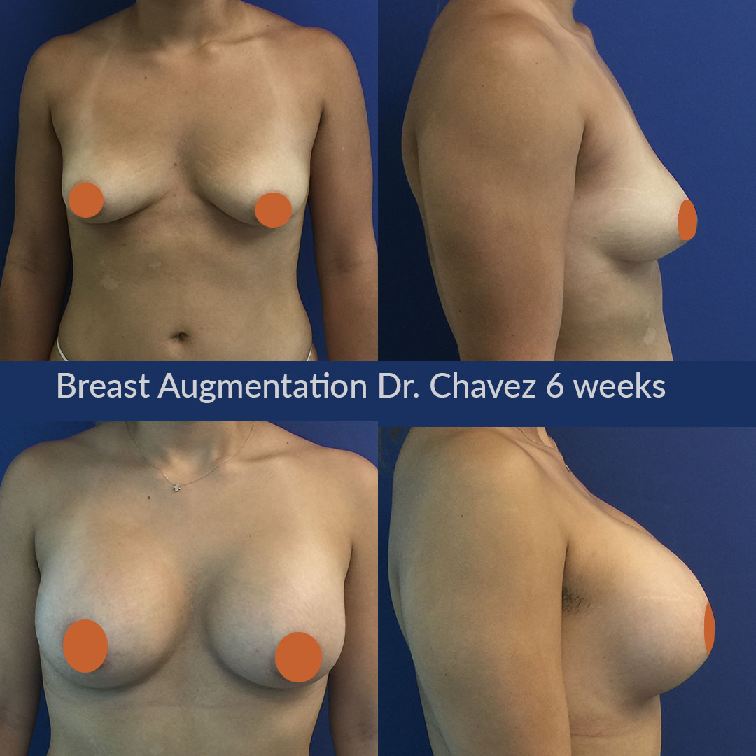 гормоны отвечающие за рост груди у женщин фото 9