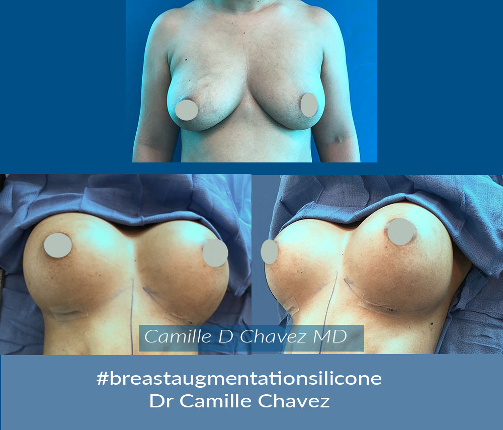 breast implant Dr. Camille Chavez